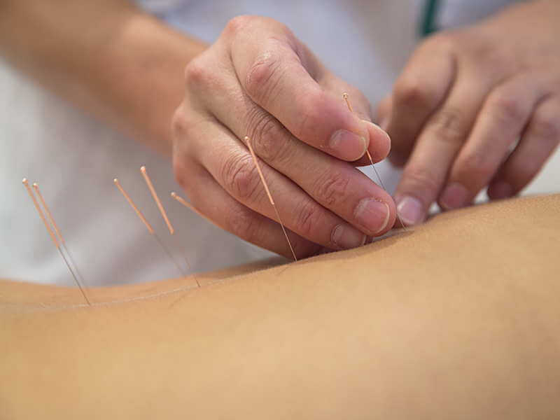 Behandlung mit Akupunkturnadeln